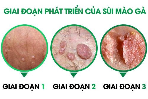 Thông tin cần biết về bệnh sùi mào gà