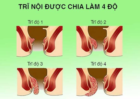 Bệnh trĩ là gì? Khi nào cần thực hiện cắt trĩ