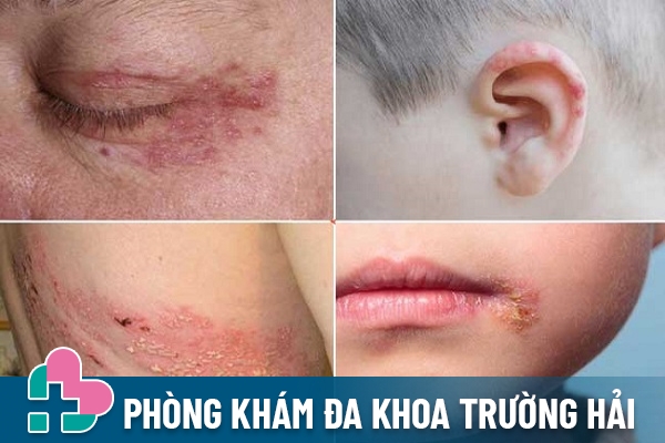 Bệnh herpes zoster khi không điều trị hiệu quả có thể gây mù lòa