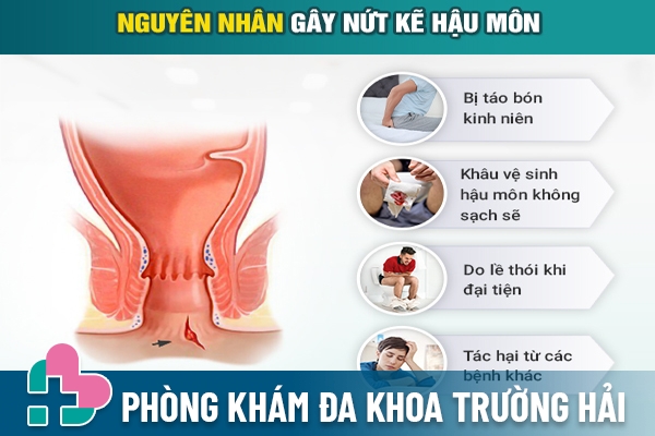 Nguyên nhân dẫn đến tình trạng bị nứt hậu môn