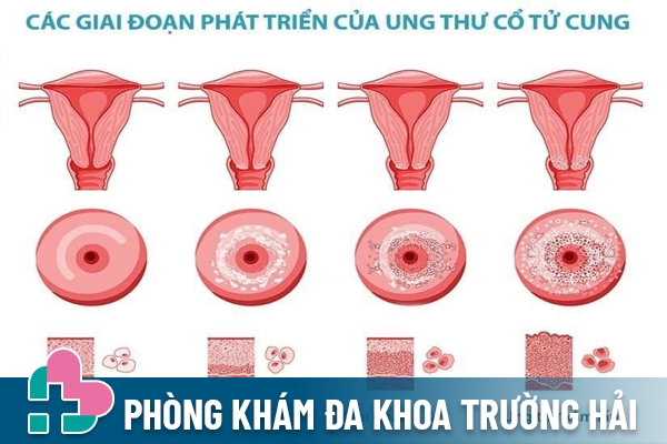 Cổ tử cung có cục cứng đó có thể là biểu hiện bệnh ung thư cổ tử cung