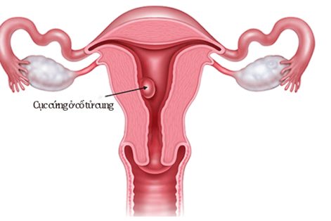 Sờ cổ tử cung có cục cứng là bệnh gì? Có nguy hiểm không?