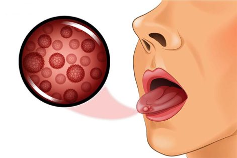Sùi mào gà ở lưỡi: Triệu chứng, nguyên nhân, cách điều trị
