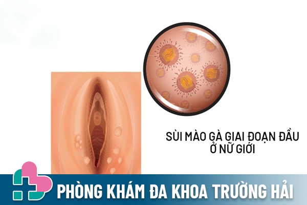 Hình ảnh mắc sùi mào gà giai đoạn đầu ở nữ giới