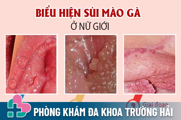 Biểu hiện bệnh qua các giai đoạn cụ thể