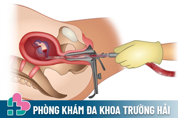 Hút thai là thủ thuật ngoại khoa