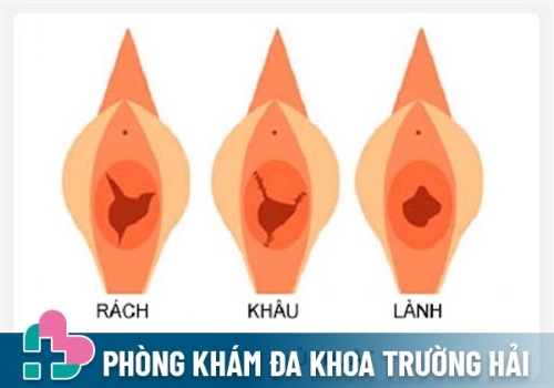 Quy trình vá màng trinh tại phòng khám đa khoa Trường Hải