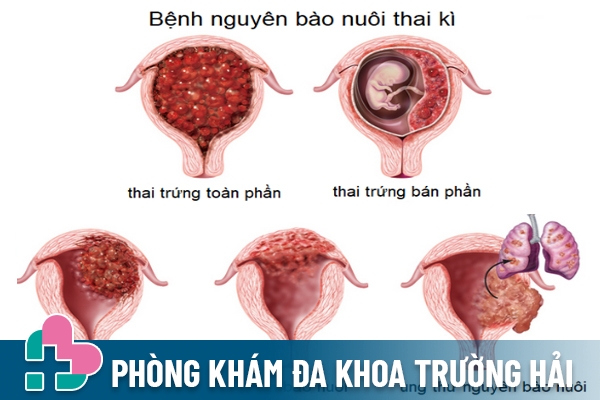 Bị thai trứng nếu chủ quan sẽ gây biến chứng ung thư tế bào nuôi