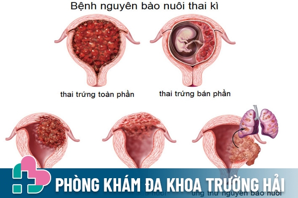 Hình ảnh cụ thể về hiện tượng thai trứng