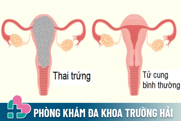 Hình ảnh cụ thể cho thấy hiện tượng thai trứng