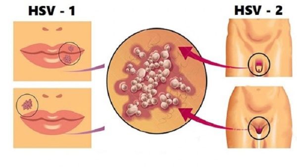 Biểu hiện mụn rộp sinh dục ở nam và nữ