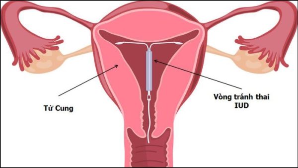 Đặt vòng tránh thai an toàn là gì?