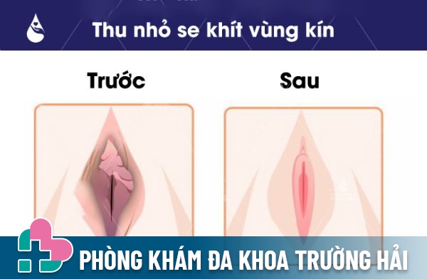 Hiệu quả sau khi thu hẹp âm đạo tại phòng khám đa khoa Hữu Nghị