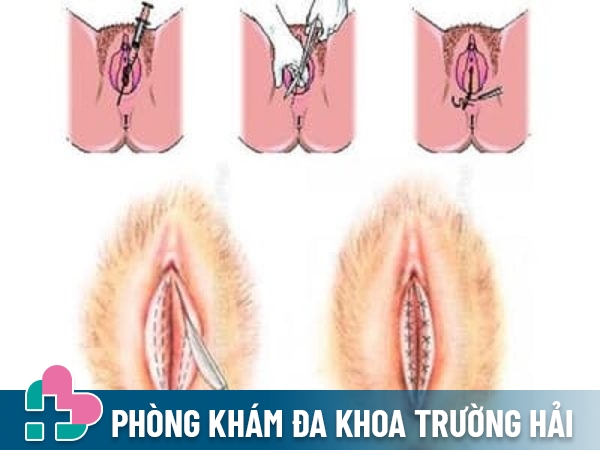 Lợi ích của việc thu hẹp âm đạo