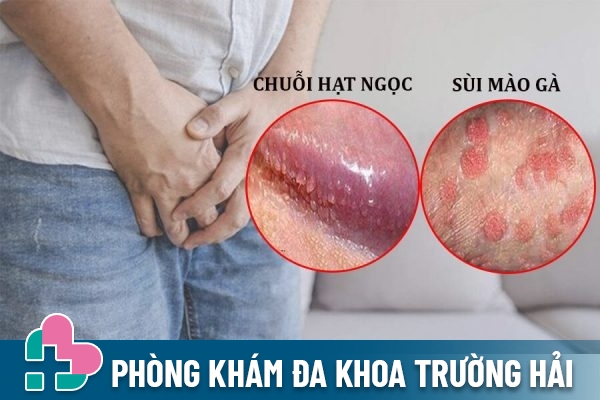 Phân biệt chuỗi hạt ngọc dương vật và sùi mào gà