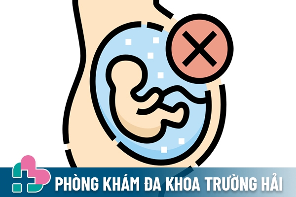 Phá thai là thủ thuật giúp kết thúc thai kỳ trước kỳ hạ sinh nở