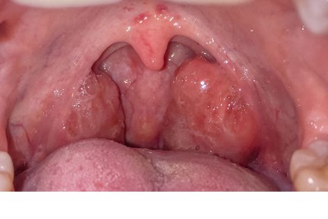 Sùi mào gà ở họng giai đoạn đầu: Nguyên nhân, dấu hiệu và điều trị
