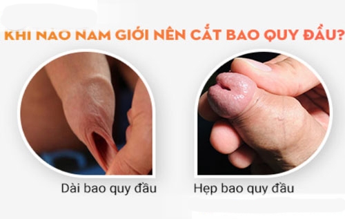 Trường hợp nào nên cắt bao quy đầu?