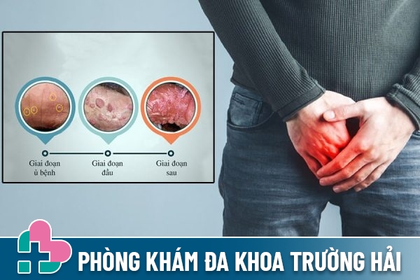 Các giai đoạn phát triển của sùi mào gà