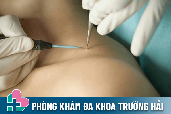 Cách điều trị sùi mào gà