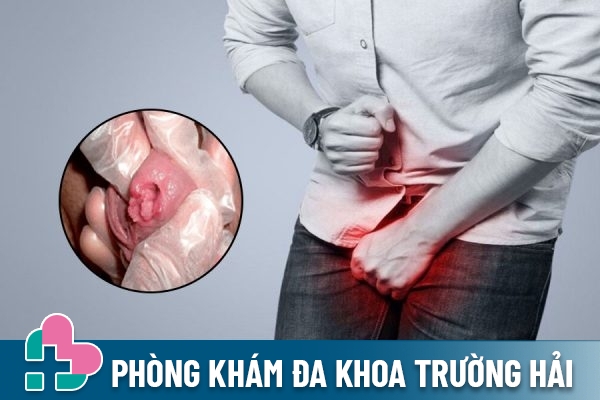 Dấu hiệu đặc trưng của sùi mào gà ở lỗ sáo