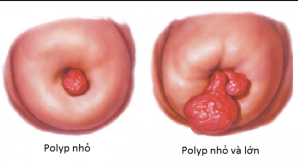 Dấu hiệu nhận biết bệnh Polyp cổ tử cung