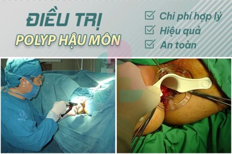 Địa chỉ khám và điều trị polyp hậu môn ở Hải Dương