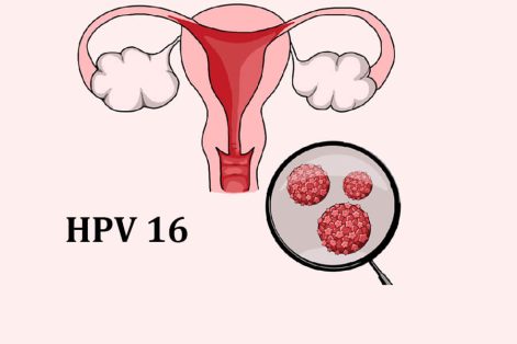 HPV type 16 là gì? Có gây ung thư hay không?