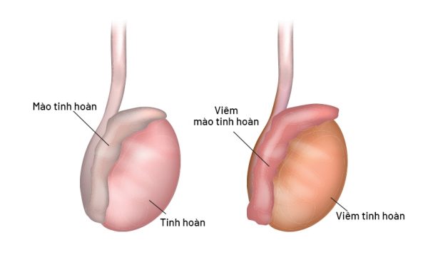 Một vài thông tin tổng quan về bệnh viêm tinh hoàn