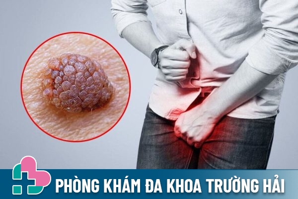 Nam giới bị sùi mào gà có con được không?