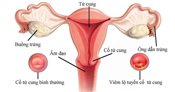 Nguyên nhân gây bệnh viêm lộ tuyến cổ tử cung