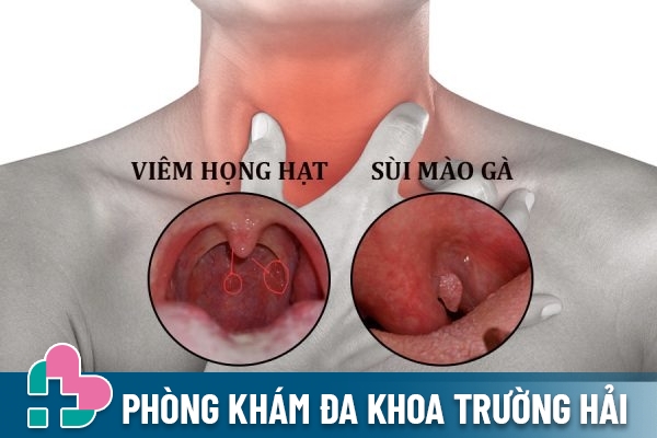 Phân biệt viêm họng hạt và sùi mào gà ở họng