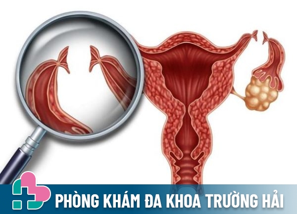 Phương pháp thắt ống dẫn trứng