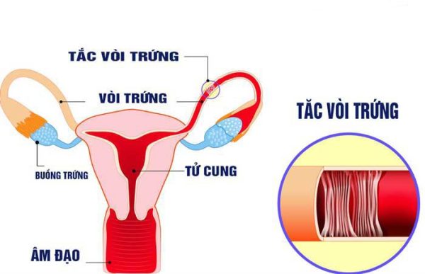 Toàn bộ về bệnh lý viêm tắc vòi trứng