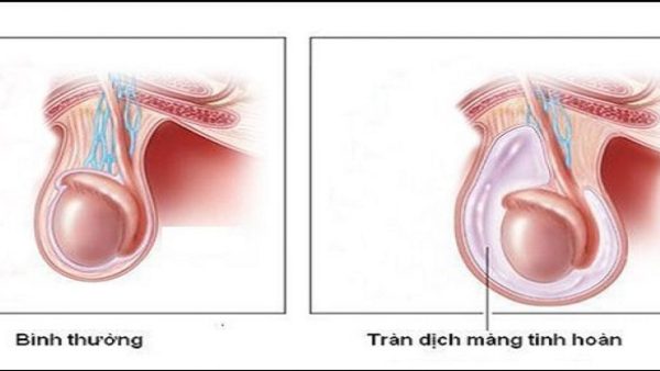 Triệu chứng của tràn dịch màng tinh hoàn