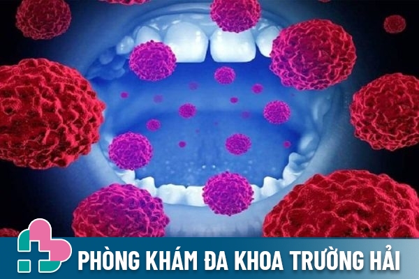 Virus HPV gây ung thư vòm họng
