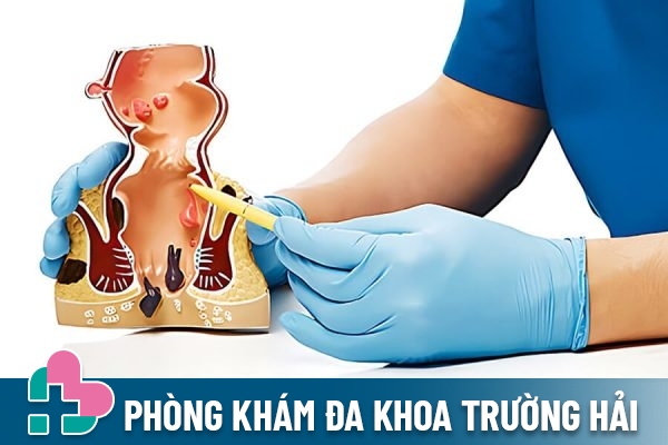 Bệnh trĩ có lây không?