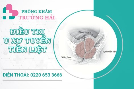 Địa chỉ chữa u xơ tuyến tiền liệt uy tín ở Thành Phố Chí Linh