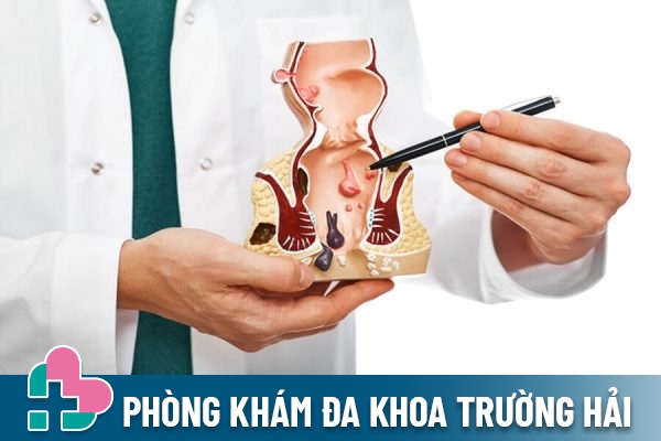 Tổng quan về bệnh trĩ