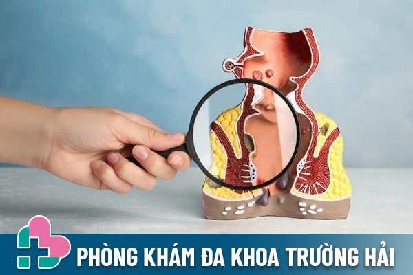 Triệu chứng bệnh trĩ