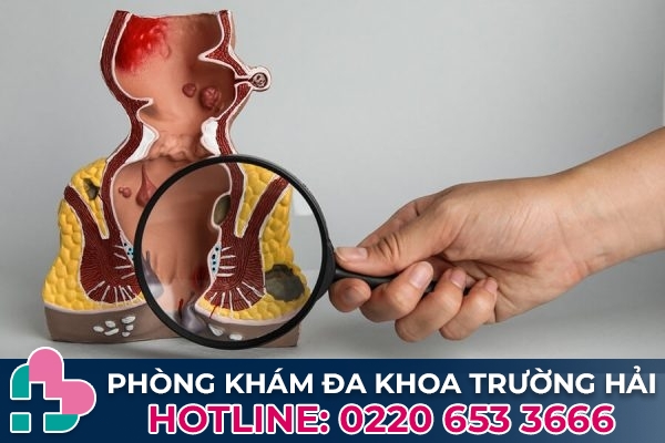 Cách phòng ngừa phù nề sau khi mổ trĩ