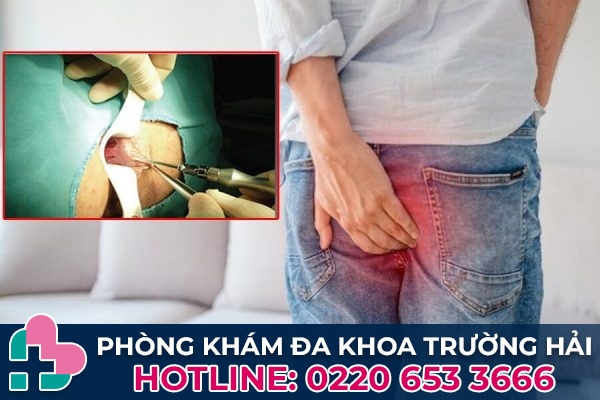 Phù nề sau khi mổ trĩ có nguy hiểm không?