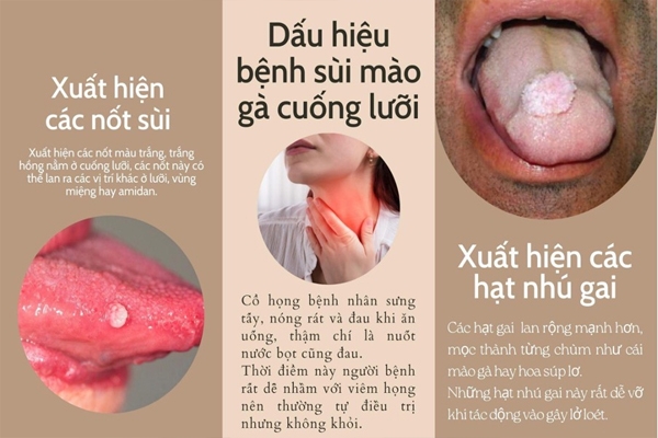 Nhận biết các triệu chứng sùi mào gà ở lưỡi