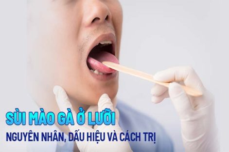 Sùi mào gà ở lưỡi: Nguyên nhân, nhận biết và điều trị
