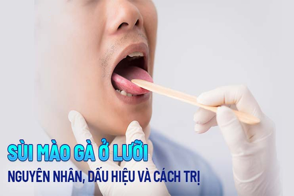 Sùi mào gà ở lưỡi: Nguyên nhân, nhận biết và điều trị