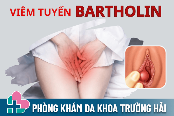 Viêm tuyến Bartholin