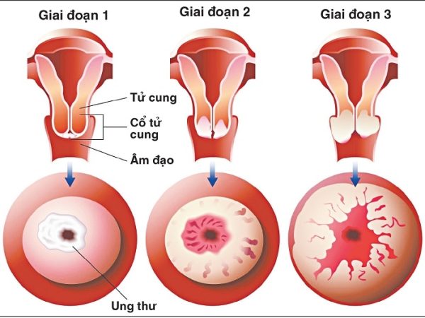 Tầm quan trọng của tầm soát ung thư